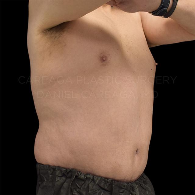Mini Tummy Tuck after at Careaga Plastic Surgery in Coral Gables, FL