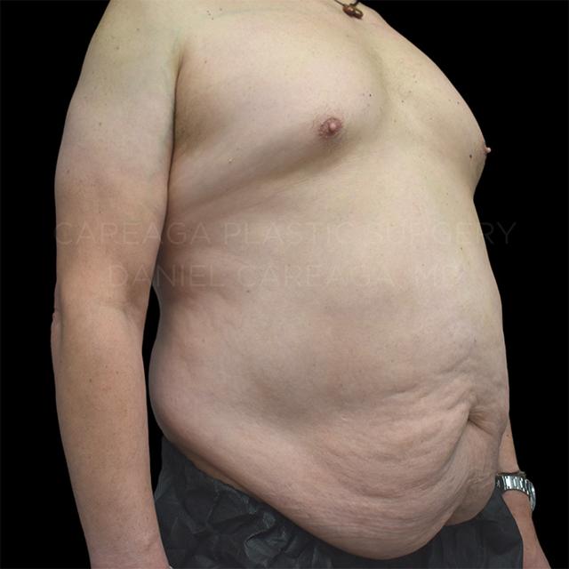 Mini Tummy Tuck before at Careaga Plastic Surgery in Coral Gables, FL