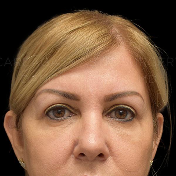 Careaga Plastic Surgery blepharoplasty after — Miami, FL