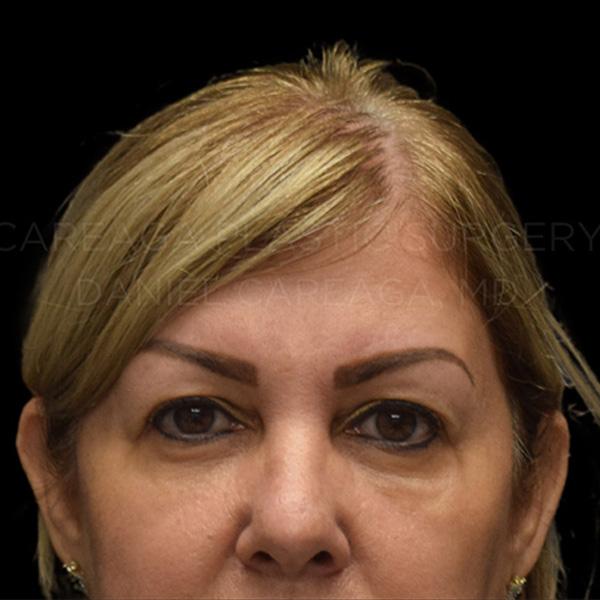 Blepharoplasty before at Careaga Plastic Surgery in Coral Gables, FL