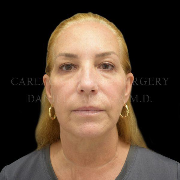 Careaga Plastic Surgery facelift after — Miami, FL