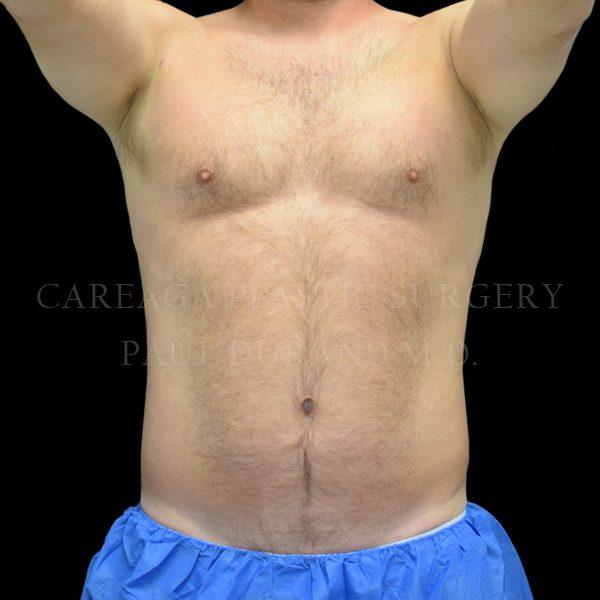 Liposuction after at Careaga Plastic Surgery in Coral Gables, FL