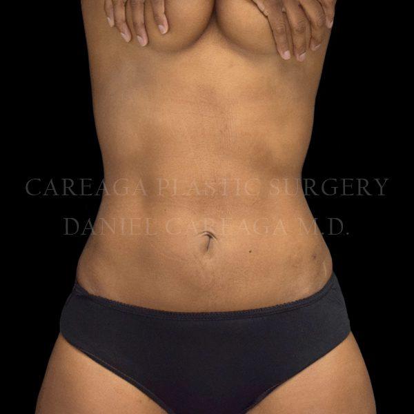 Liposuction after at Careaga Plastic Surgery in Coral Gables, FL