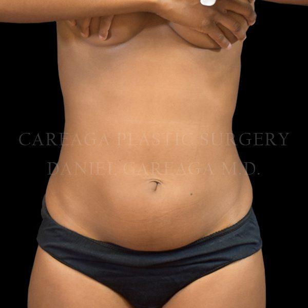Liposuction before at Careaga Plastic Surgery in Coral Gables, FL