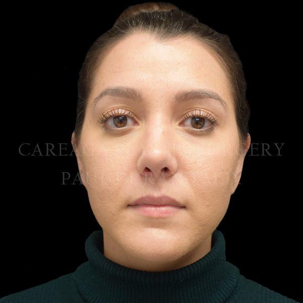 Rhinoplasty after at Careaga Plastic Surgery in Miami, FL