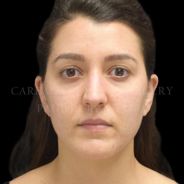 Rhinoplasty before at Careaga Plastic Surgery in Miami, FL