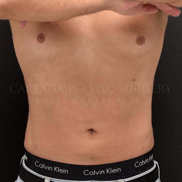 Liposuction after at Careaga Plastic Surgery in Coral Gables, FL