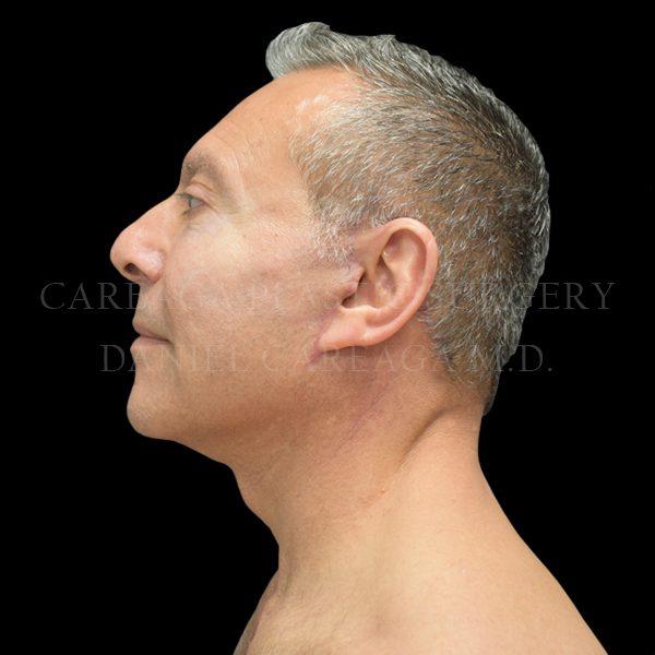 Careaga Plastic Surgery facelift after — Miami, FL