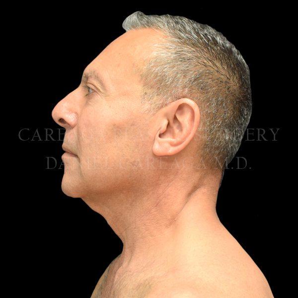 Facelift before at Careaga Plastic Surgery in Miami, FL