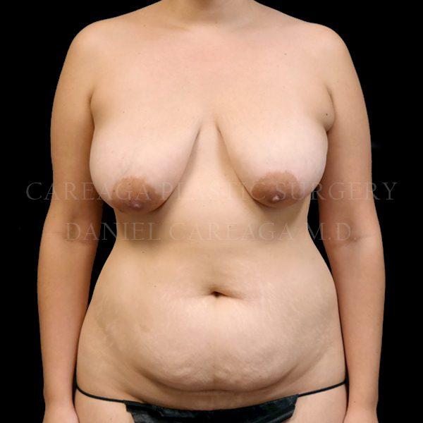 Mommy Makeover before at Careaga Plastic Surgery in Coral Gables, FL