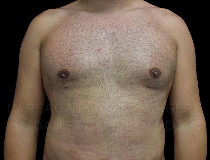 Careaga Plastic Surgery gynecomastia after — Miami, FL