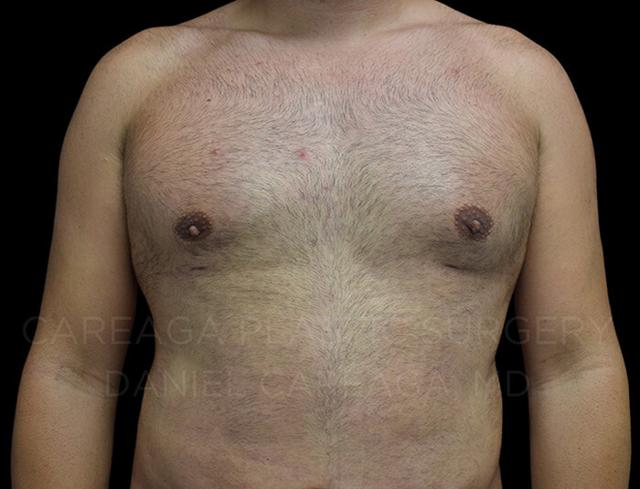 Gynecomastia Surgery after at Careaga Plastic Surgery in Miami, FL