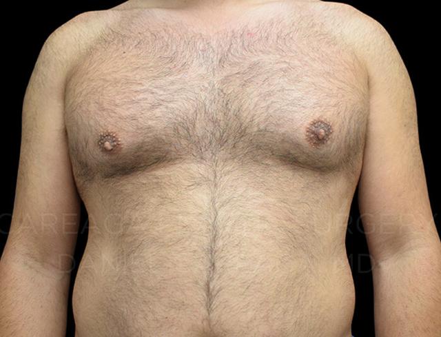 Gynecomastia Surgery before at Careaga Plastic Surgery in Miami, FL