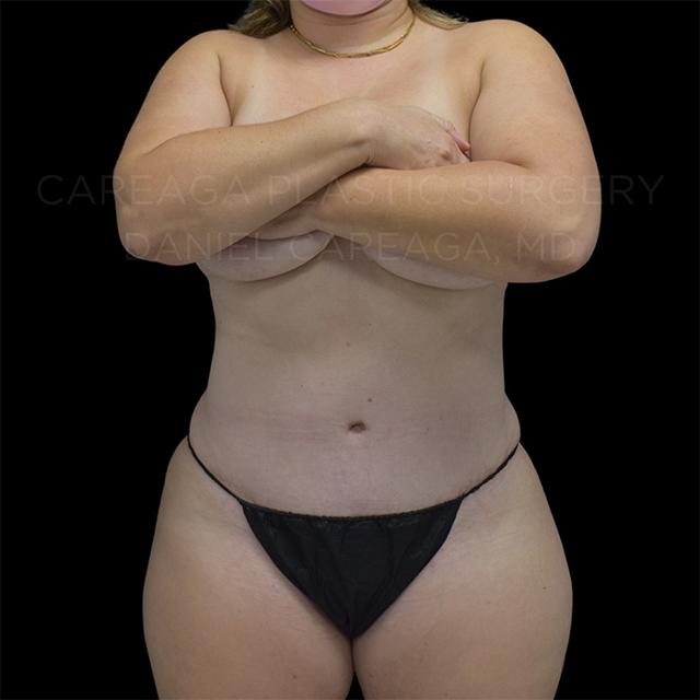 Mini Tummy Tuck after at Careaga Plastic Surgery in Coral Gables, FL