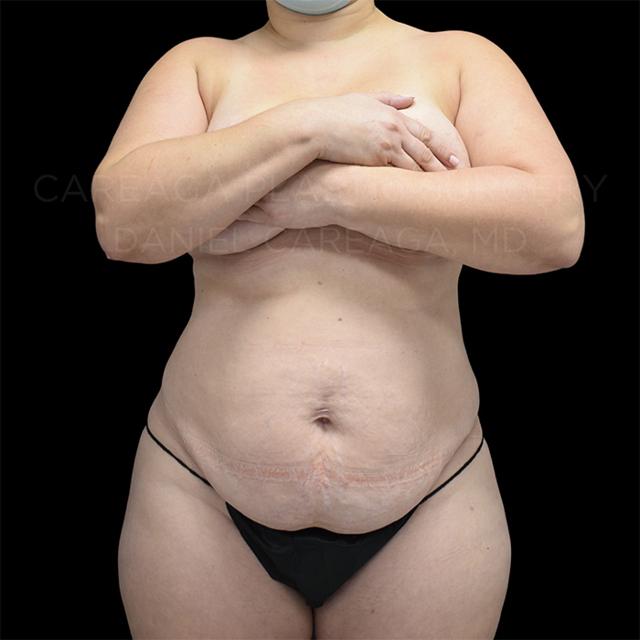 Mini Tummy Tuck before at Careaga Plastic Surgery in Coral Gables, FL
