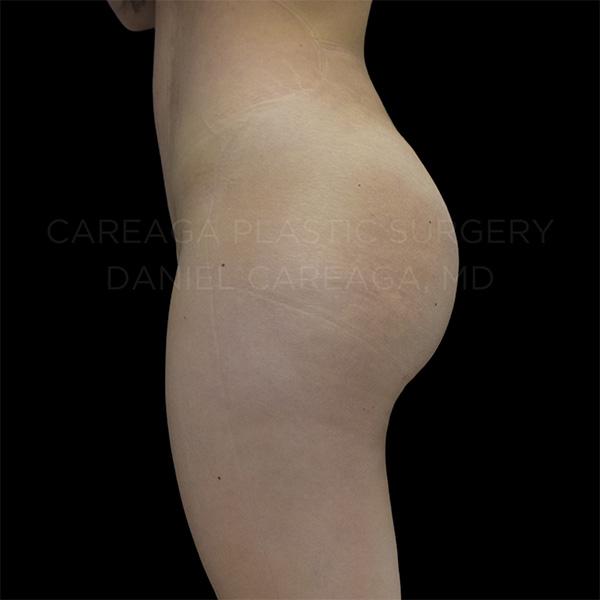 Brazilian Butt Lift after at Careaga Plastic Surgery in Miami, FL