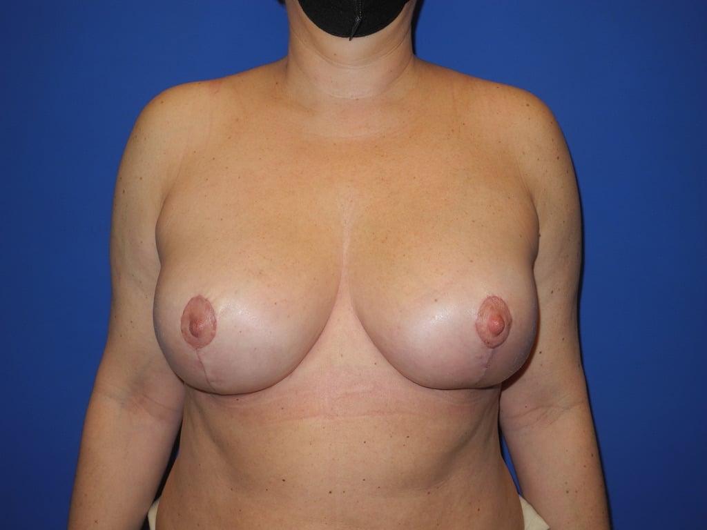 Shahram Salemy, MD breast augmentation after — Seattle, WA