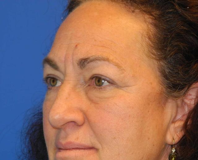 Blepharoplasty before at Shahram Salemy, MD in Seattle, WA