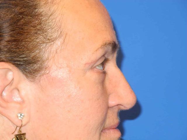 Blepharoplasty after at Shahram Salemy, MD in Seattle, WA
