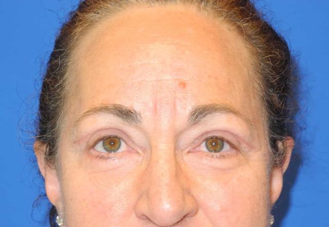 Blepharoplasty after at Shahram Salemy, MD in Seattle, WA