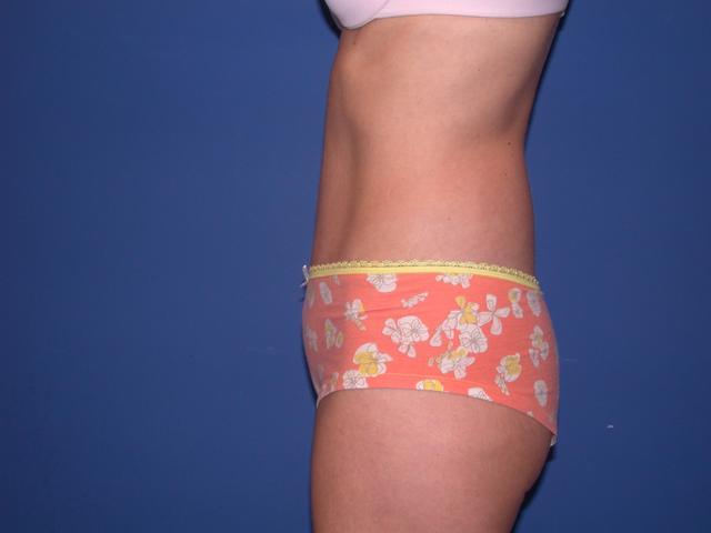 Mini Tummy Tuck after at Shahram Salemy, MD in Seattle, WA