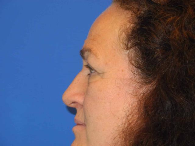 Blepharoplasty before at Shahram Salemy, MD in Seattle, WA