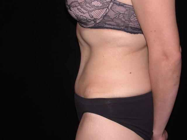 Mini Tummy Tuck after at Shahram Salemy, MD in Seattle, WA