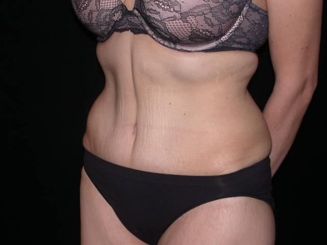Mini Tummy Tuck after at Shahram Salemy, MD in Seattle, WA
