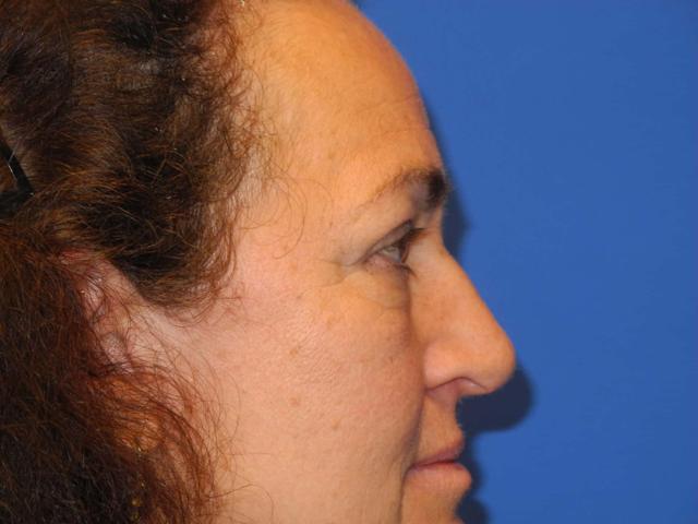 Blepharoplasty before at Shahram Salemy, MD in Seattle, WA