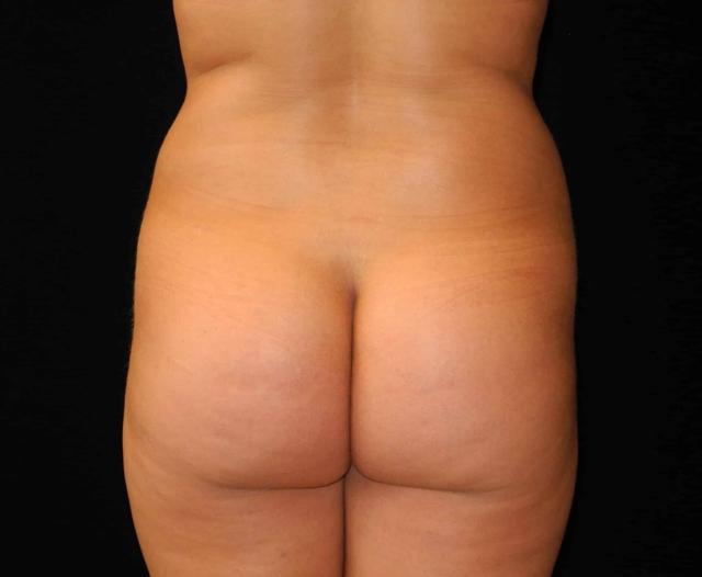Brazilian Butt Lift after at Shahram Salemy, MD in Seattle, WA
