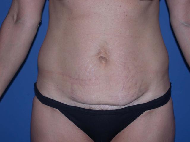 Mini Tummy Tuck before at Shahram Salemy, MD in Seattle, WA