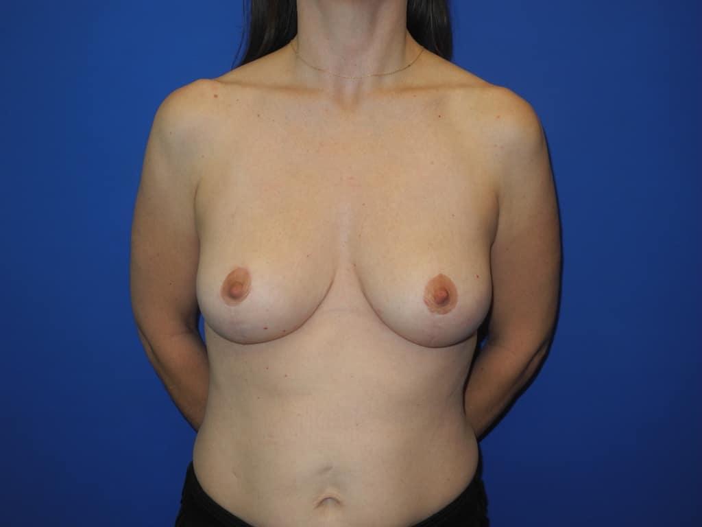Shahram Salemy, MD breast augmentation after — Seattle, WA