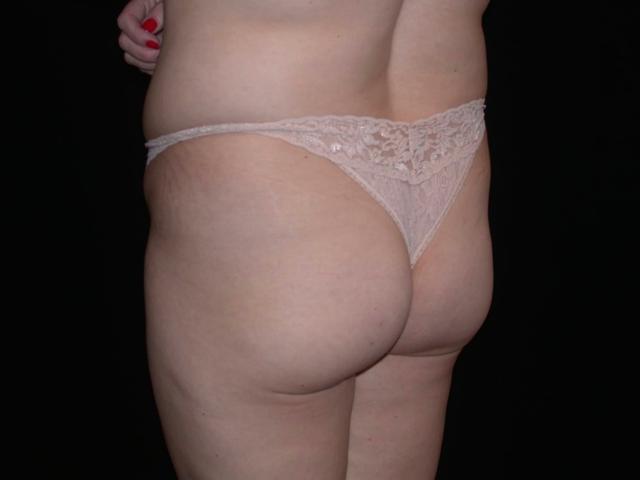 Brazilian Butt Lift before at Shahram Salemy, MD in Seattle, WA