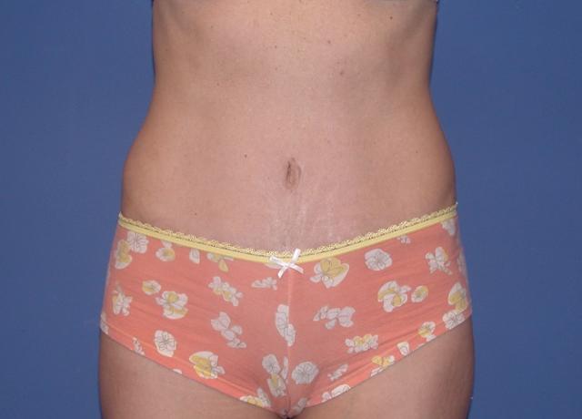 Mini Tummy Tuck after at Shahram Salemy, MD in Seattle, WA