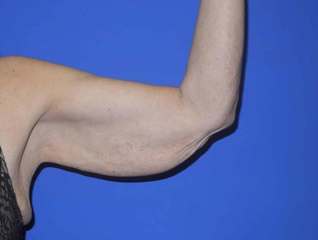 Arm Lift before at Shahram Salemy, MD in Seattle, WA