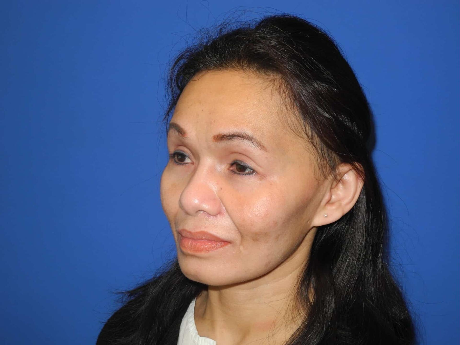 Shahram Salemy, MD rhinoplasty after — Seattle, WA