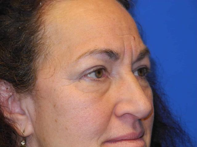 Blepharoplasty before at Shahram Salemy, MD in Seattle, WA