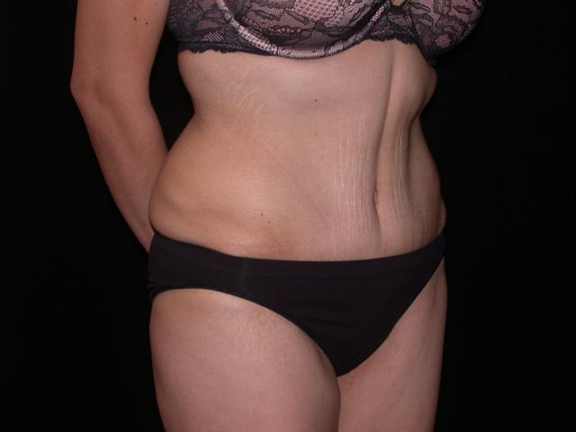 Mini Tummy Tuck after at Shahram Salemy, MD in Seattle, WA