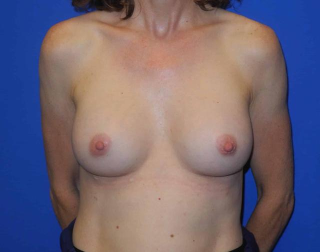 Breast Augmentation after at Shahram Salemy, MD in Seattle, WA