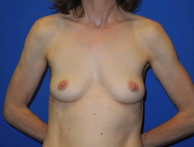 Breast Augmentation before at Shahram Salemy, MD in Seattle, WA