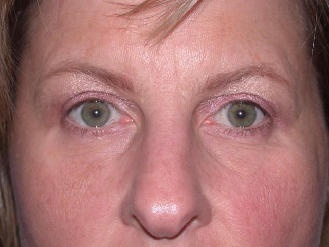 Blepharoplasty after at Shahram Salemy, MD in Seattle, WA