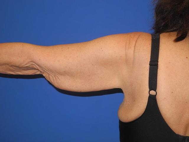 Arm Lift before at Shahram Salemy, MD in Seattle, WA