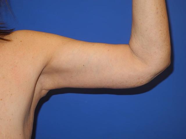 Arm Lift after at Shahram Salemy, MD in Seattle, WA