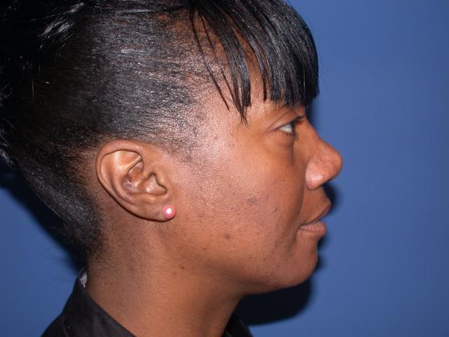 Rhinoplasty after at Shahram Salemy, MD in Seattle, WA
