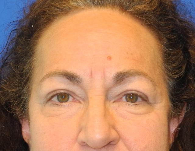 Blepharoplasty before at Shahram Salemy, MD in Seattle, WA