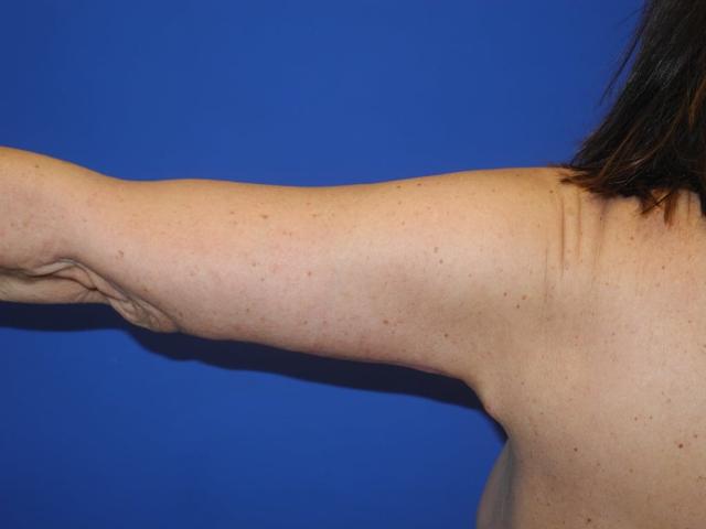 Arm Lift after at Shahram Salemy, MD in Seattle, WA