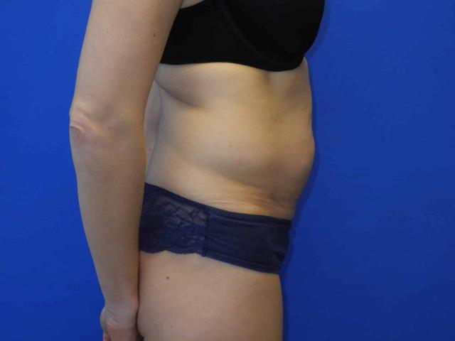 Mini Tummy Tuck before at Shahram Salemy, MD in Seattle, WA