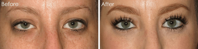 Blepharoplasty result at Eyesthetica - Irvine Eyelid Surgery in Irvine, CA