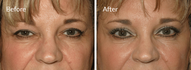 Brow Lift result at Eyesthetica - Irvine Eyelid Surgery in Irvine, CA