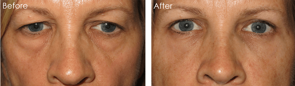 Eyesthetica - Irvine Eyelid Surgery result — Irvine, CA